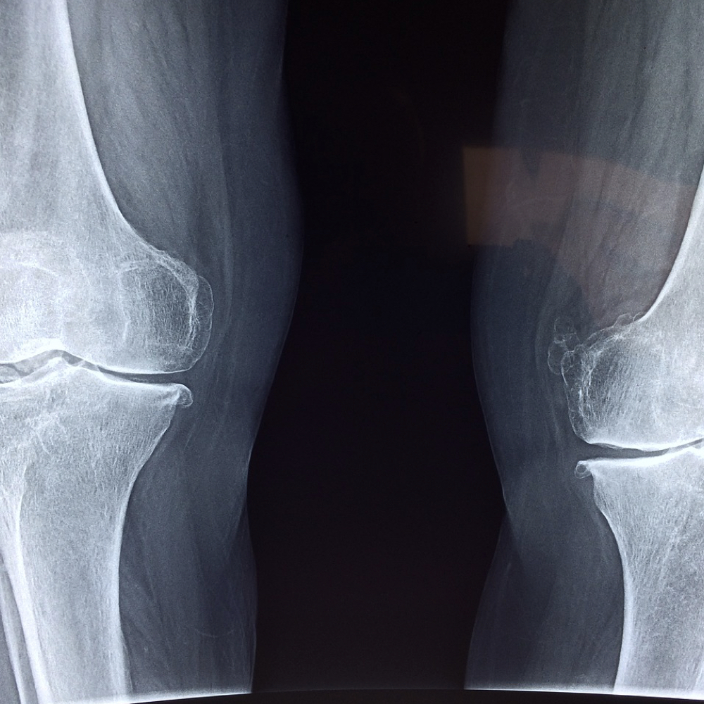 Bone Health