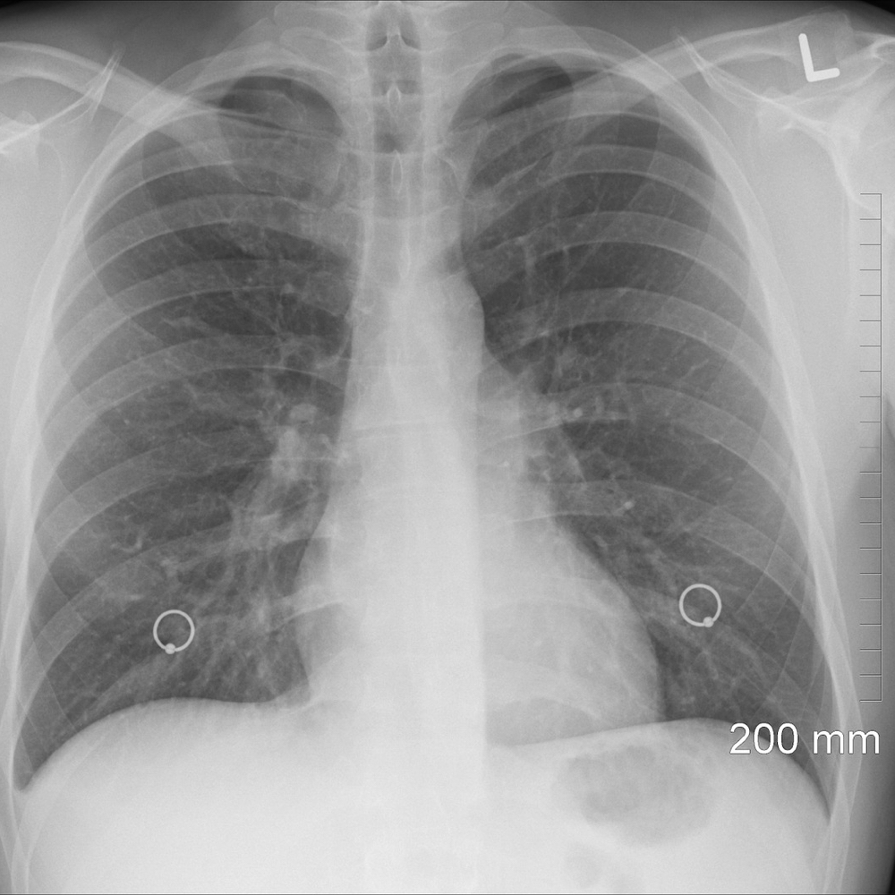 Cáncer De Pulmón