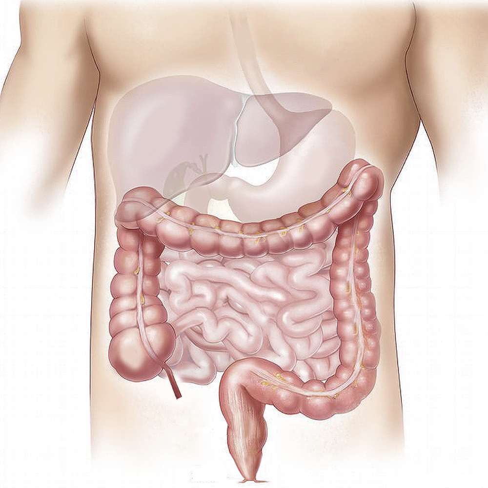Enfermedad De Crohn
