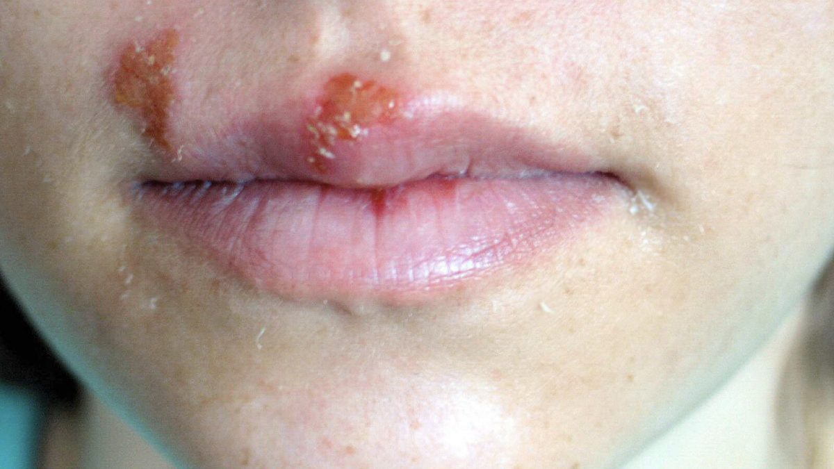 mouth with cold sores