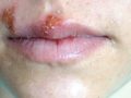 mouth with cold sores