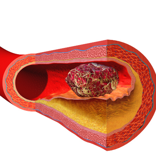 Blood Clots