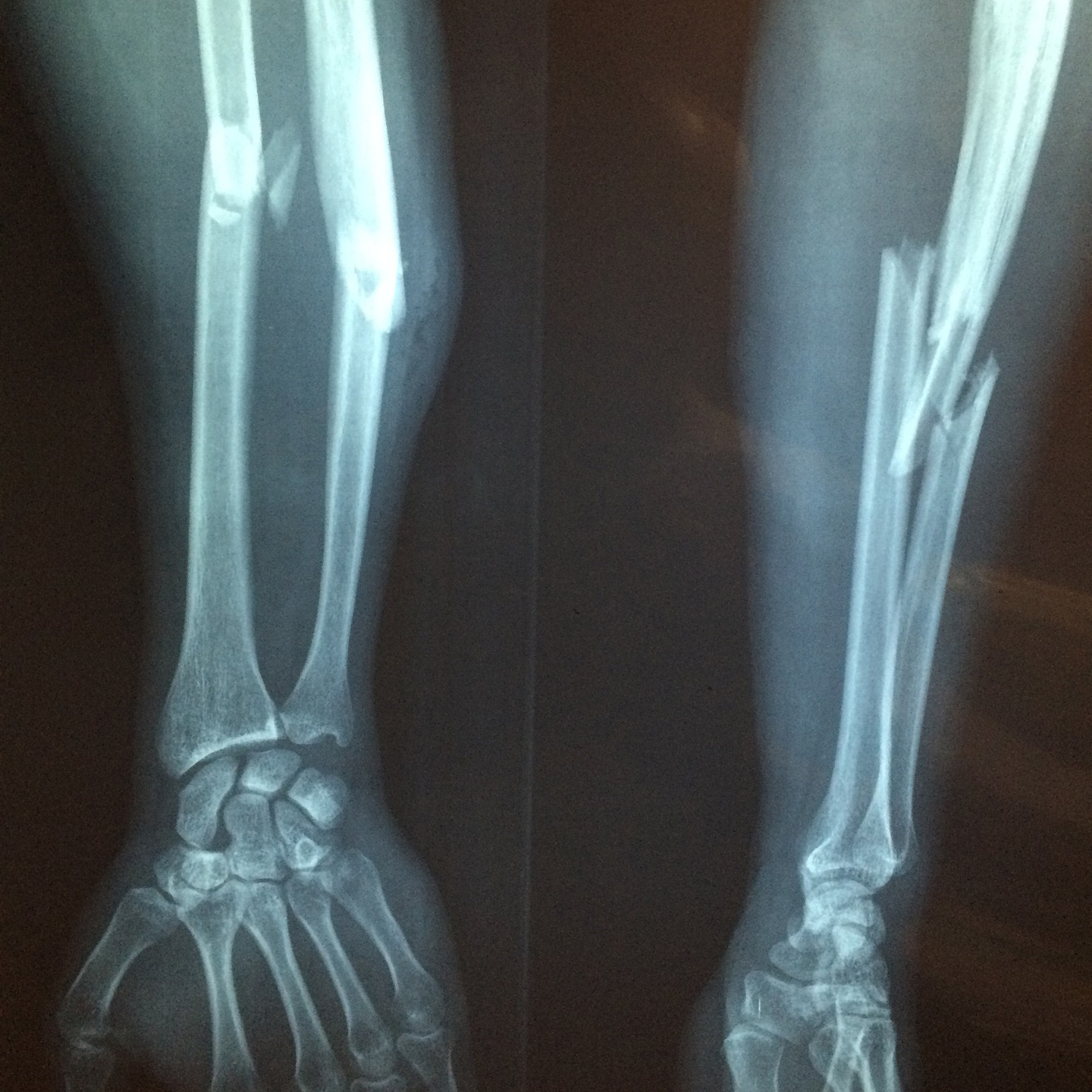 Bone Fractures