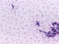 Long-Term Effects of Toxoplasmosis Brain Infection