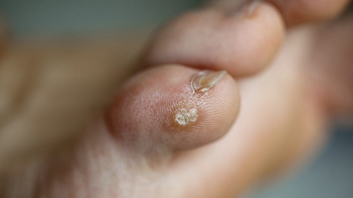 Duct Tape and Wart Removal