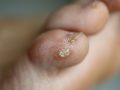 Duct Tape and Wart Removal