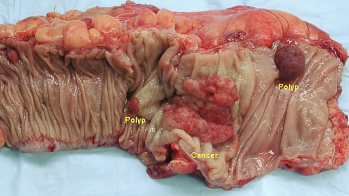 Resistant Starch and Colon Cancer