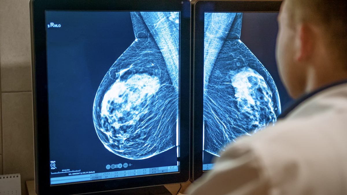 mammogram