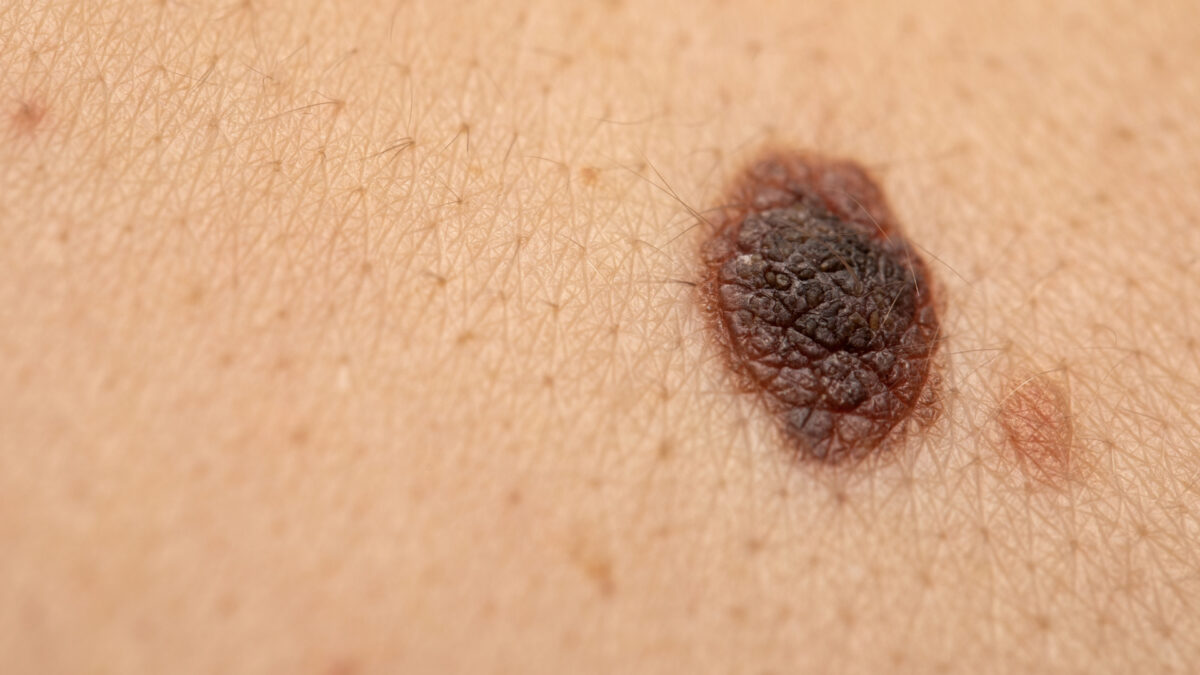 Skin cancer