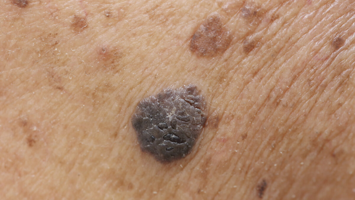 Skin mole