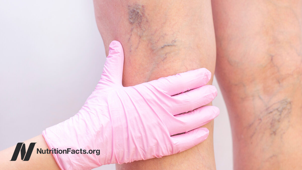 Clinician inspecting varicose veins on woman’s leg