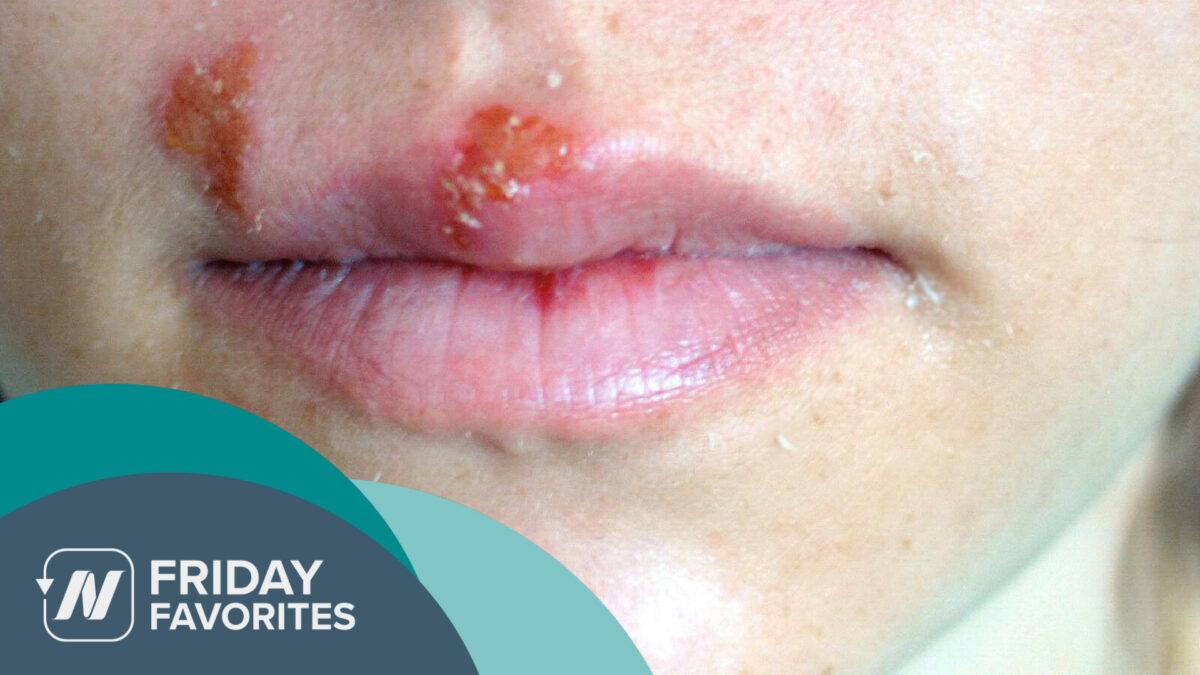 mouth with cold sores