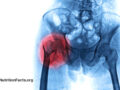 Scientific illustration of x ray with red highlight over fracture