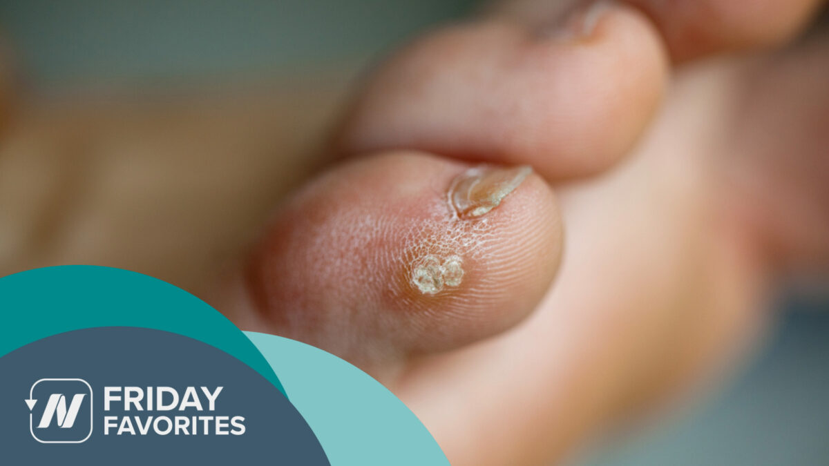 a foot with a wart