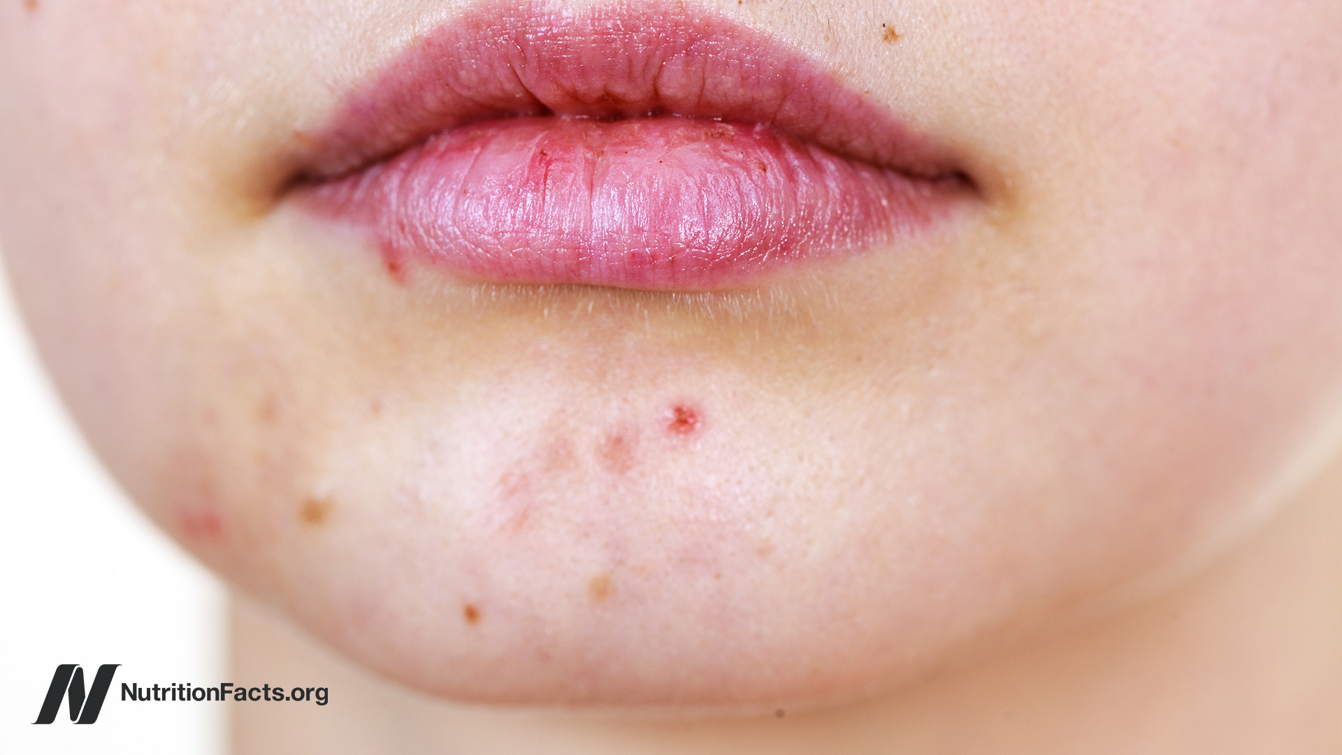 b12 face injection Are B12 Shots Safe? Royal Palm Beach Medical Group