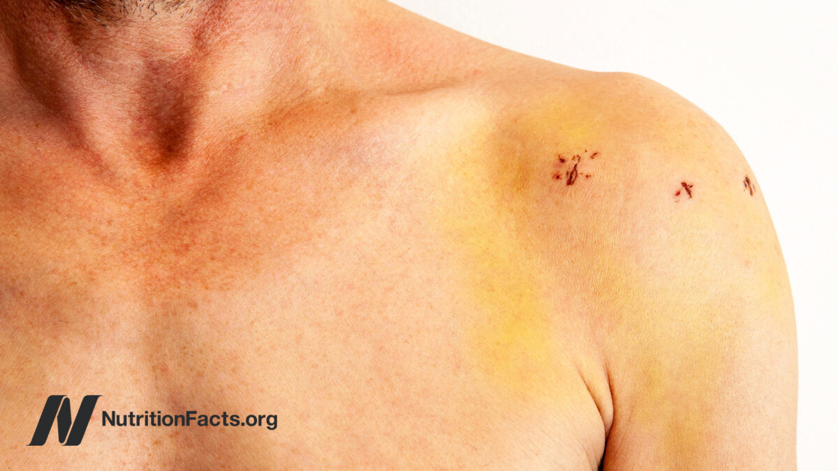Close-up view of a shoulder with incision scars after a surgical procedure