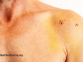 Close-up view of a shoulder with incision scars after a surgical procedure